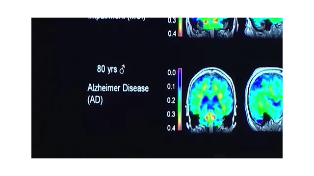 Advocates and Lawmakers Call for Changes to Medicare’s Coverage of Alzheimer’s Treatments